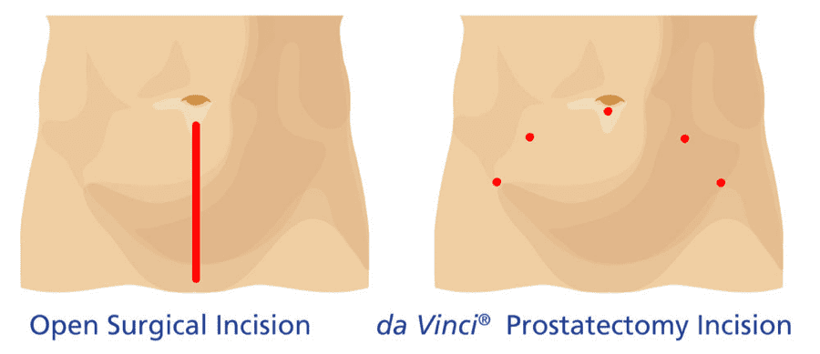Illustration of types of incisions, standard vs. da Vinci, on a male's abdomen Illustration of types of incisions, standard vs. da Vinci, on a male's abdomen