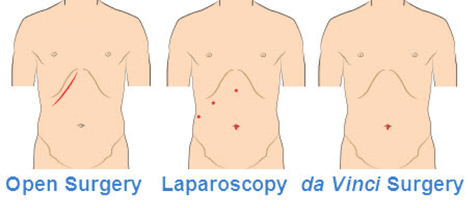 Illustration of three types of surgery, traditional open surgery vs. Laparoscopy vs. da Vinci surgery Illustration of three types of surgery, traditional open surgery vs. Laparoscopy vs. da Vinci surgery