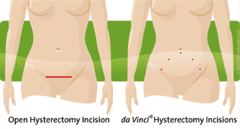 illustration of incision types, standard vs. da Vinci, on women's abdomen illustration of incision types, standard vs. da Vinci, on women's abdomen
