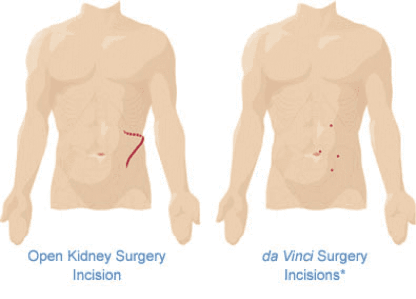 Illustration of open kidney surgery incision vs. da Vinci surgery incision on male body Illustration of open kidney surgery incision vs. da Vinci surgery incision on male body
